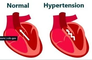 obat darah tinggi cardiomed membantu penyembuhan tekanan darah tinggi 